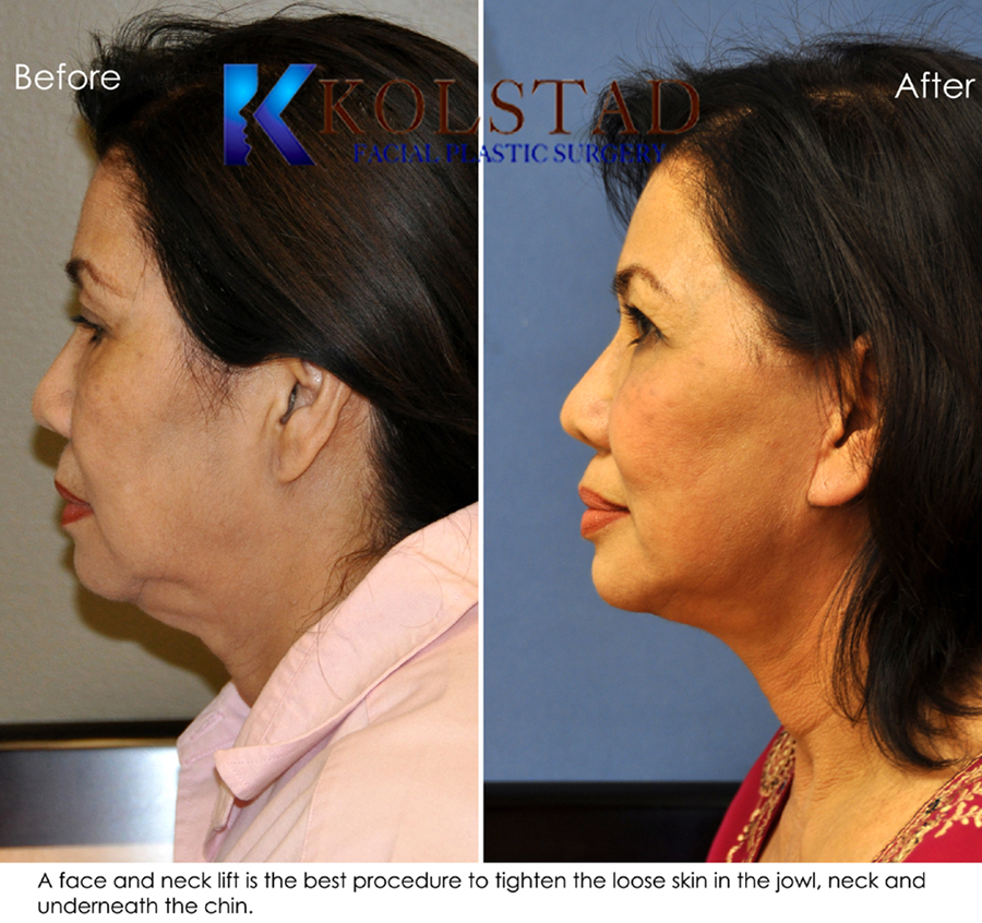 hairstyles to hide facelift scars hairstyles to hide facelift scars