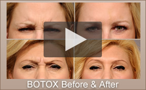 Botox Specialist La Jolla, CA