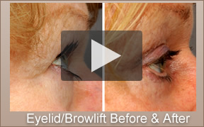Eyelid and BrowLift La Jolla, CA