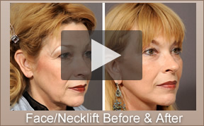 Face and Neck Lift La Jolla, CA