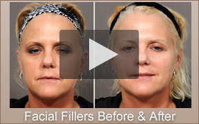 Facial Fillers Before and After La Jolla, CA