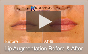 La Jolla Lip Augmentation