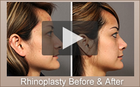 African American Rhinoplasty Surgeon La Jolla, CA