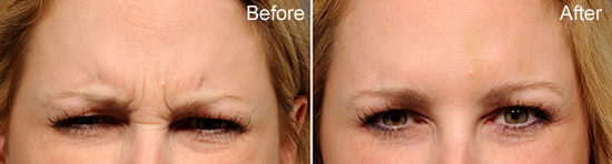 Botox Specialist La Jolla, CA