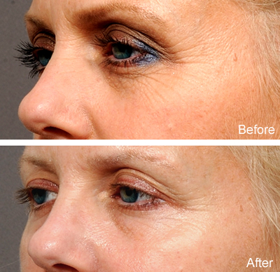 Botox Specialist La Jolla, CA