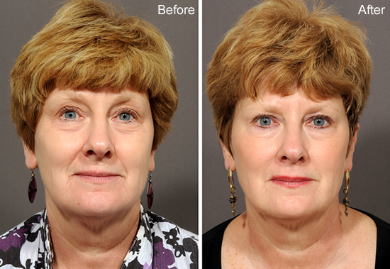 Botox Specialist La Jolla, CA