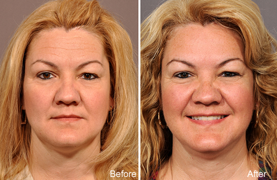 Botox Specialist La Jolla, CA