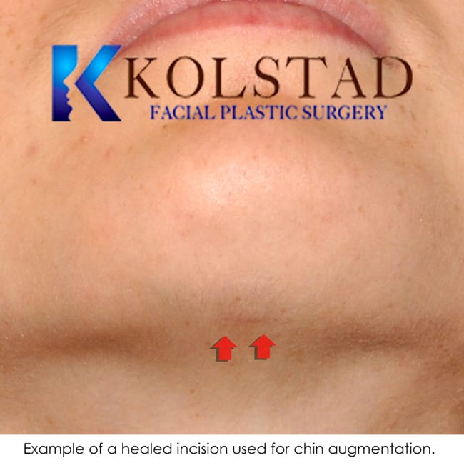 san diego chin augmentation scar 35 Dr. Kolstad San Diego Facial