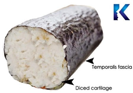 DCF graft diced cartilage fascia graft