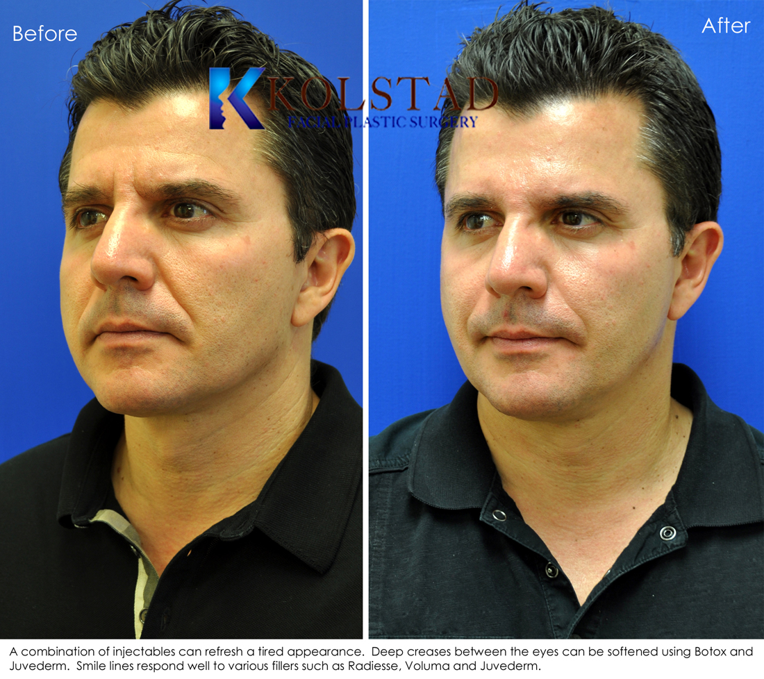 Radiesse to smile lines, nasolabial folds filler, Juvederm to smile lines