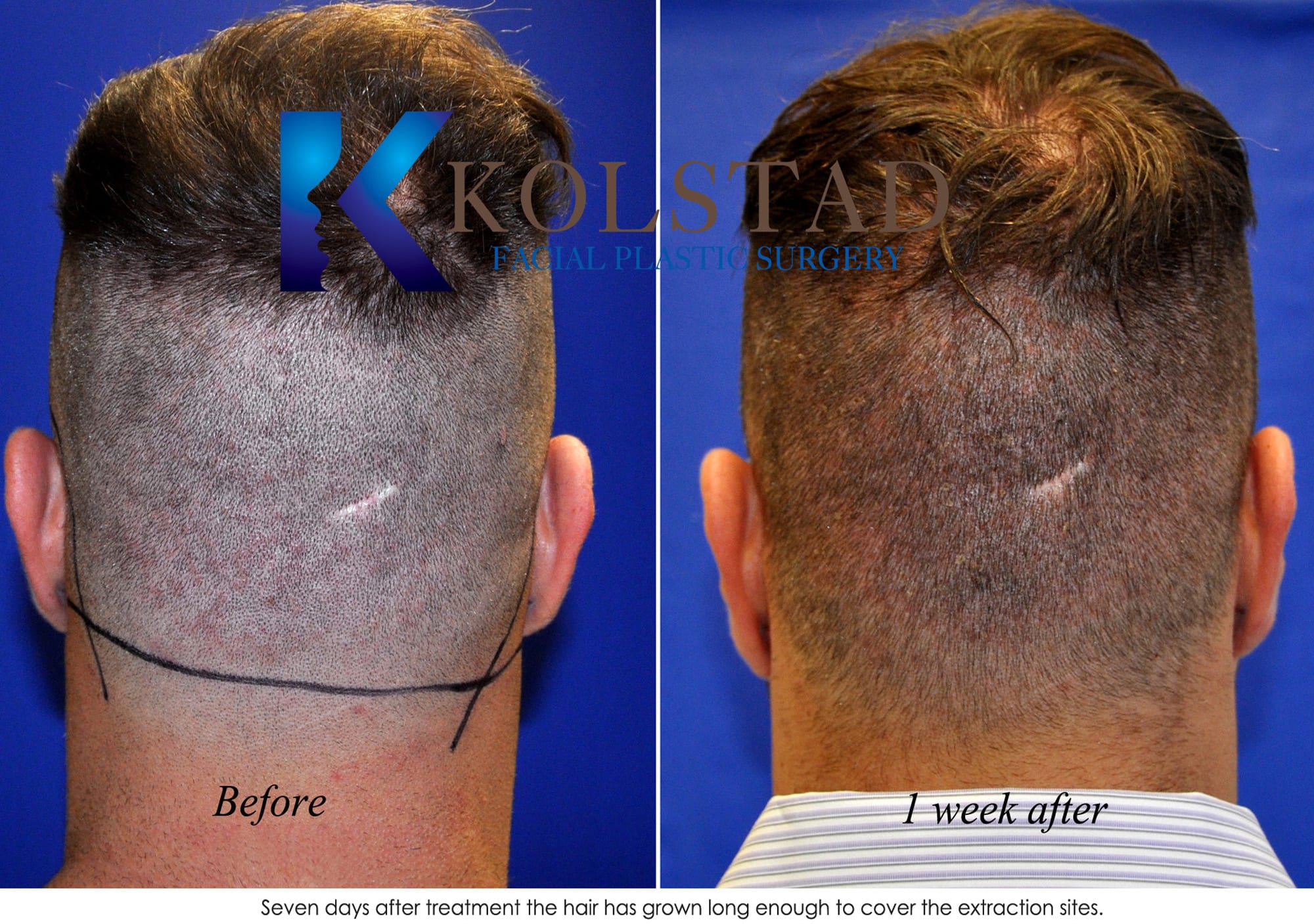 Hair Restoration Before & After Gallery Dr. Kolstad San Diego
