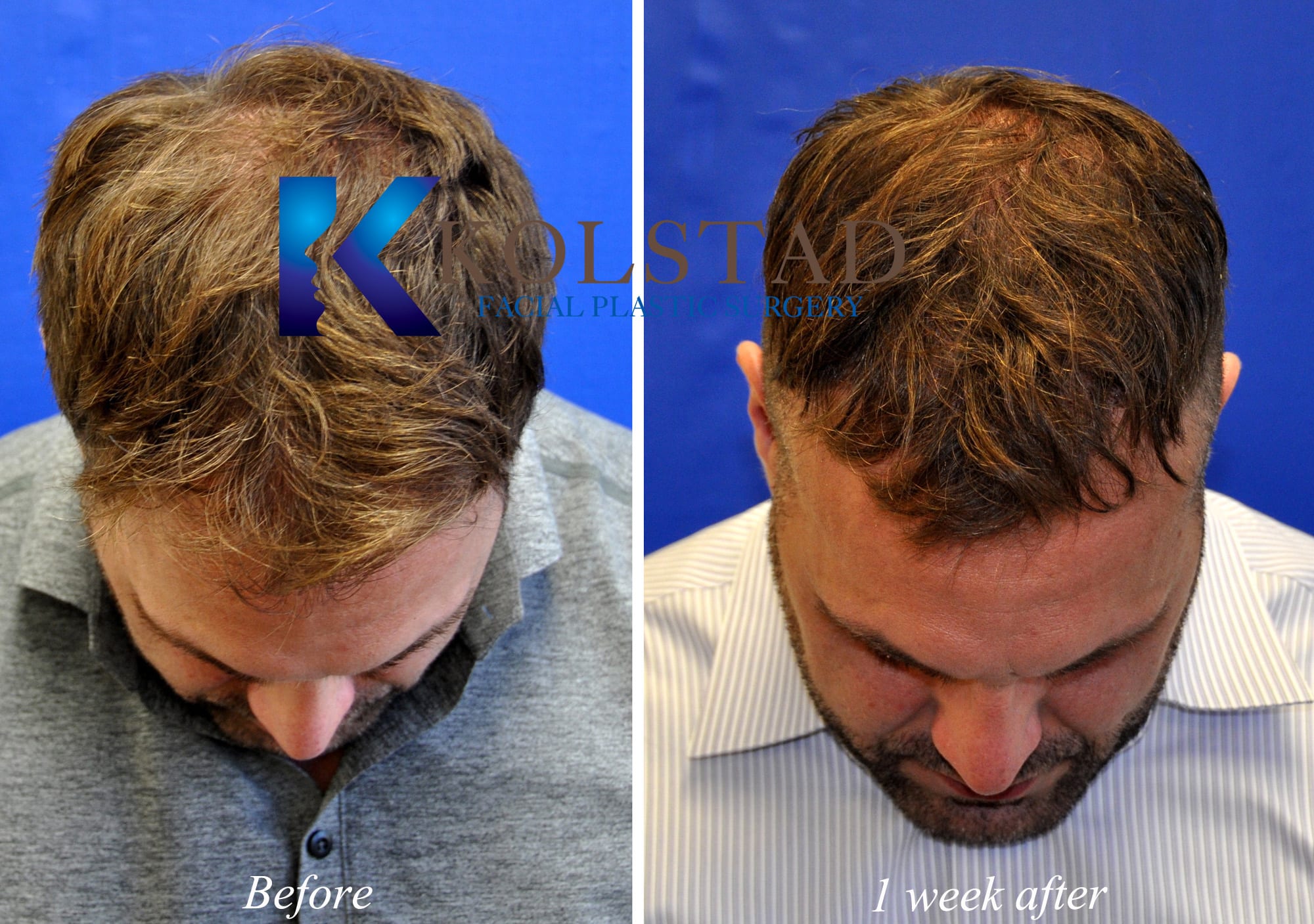Hair Transplant San Diego Dr. Kolstad Facial Plastics & Hair Restoration