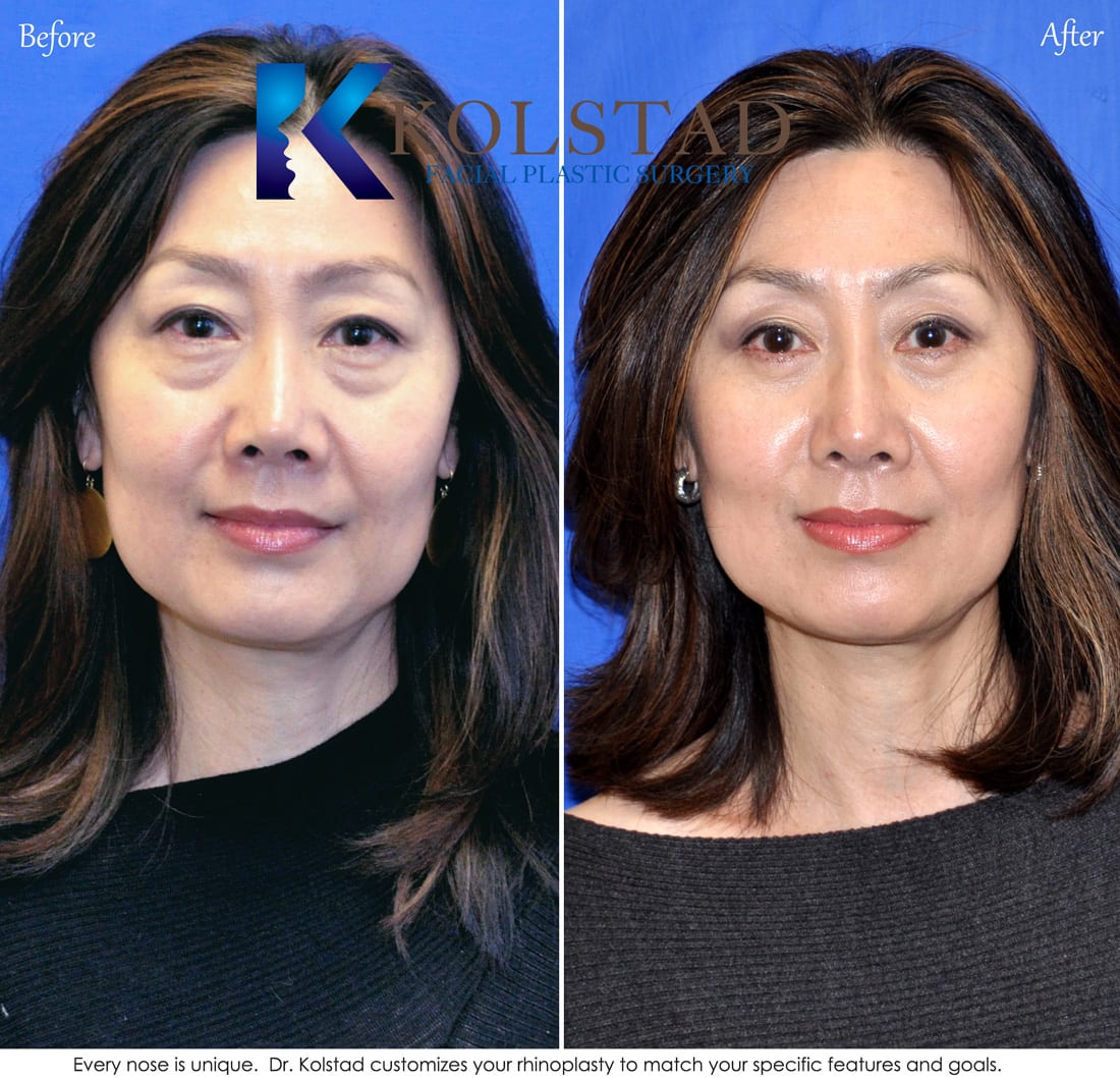 Rhinoplasty before and after pictures asian dresses Rhinoplasty before and after pictures asian dresses