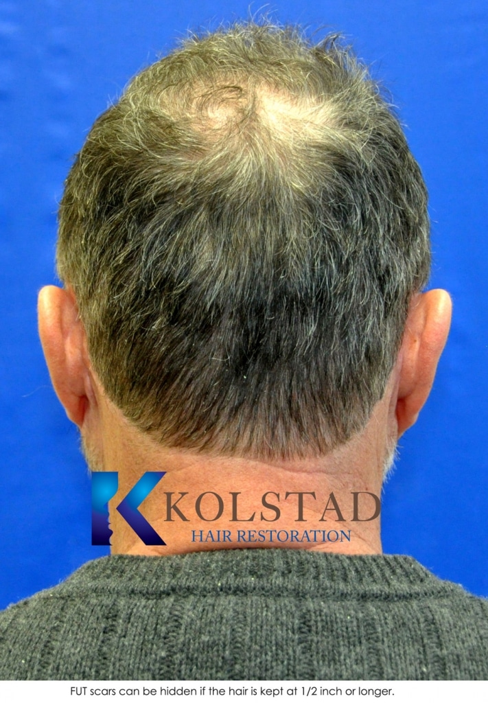hair-transplant-san-diego-51-copy
