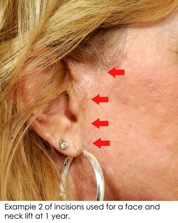 Facelift scar, healed facelift incisions, pretragal face