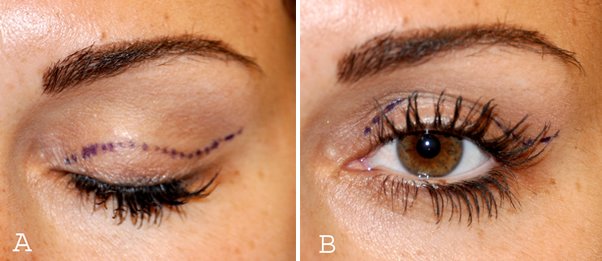 incisions-used-for-an-upper-eyelid-lift-blepharoplasty