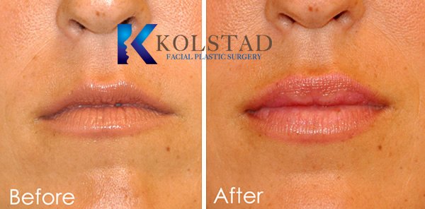 lip-augmentation