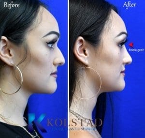 radix graft rhinoplasty