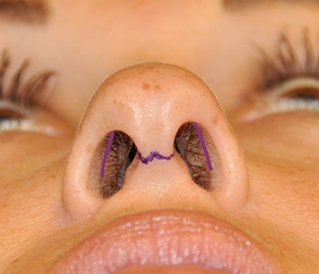 rhinoplasty-incision
