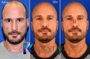 spreader graft rhinoplasty