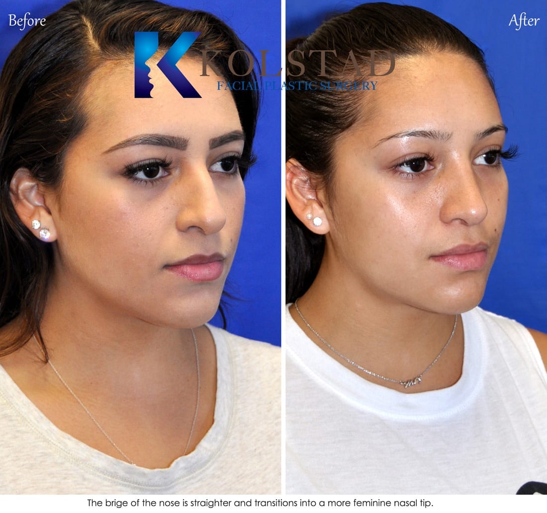 Hispanic Rhinoplasty Before &amp; After Dr. Kolstad Facial
