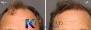 hair loss treatment