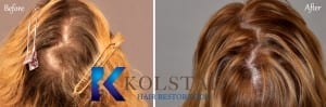 female hair loss
