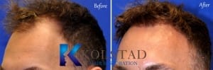 FUE hair transplant san diego