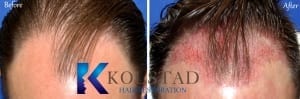 san diego hair transplant