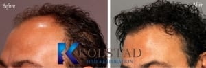 san diego hair transplant