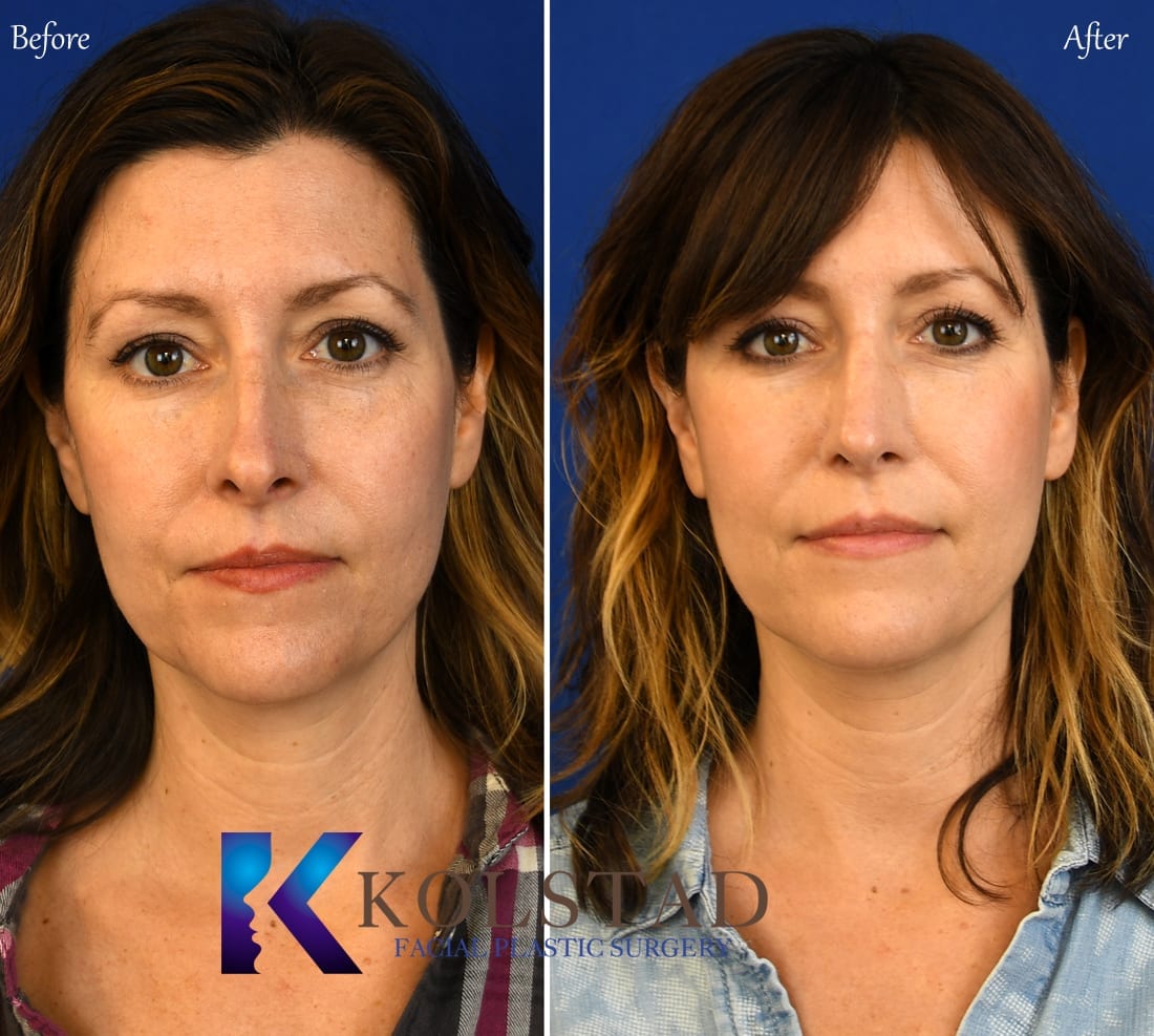 Rhinoplasty Results San Diego, Nose Job Pictures