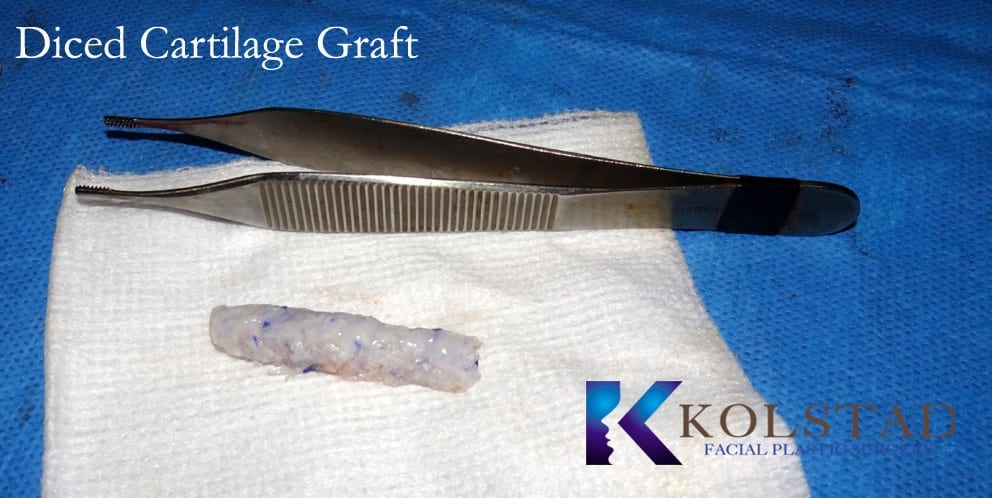 diced cartilage graft rhinoplasty